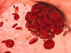 Blood-Clot