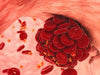 Blood-Clot