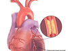 Coronary-heart-disease