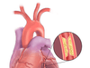 Coronary-heart-disease