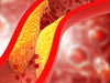 vascular-plaque
