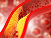 vascular-plaque
