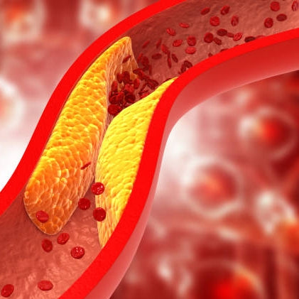 vascular-plaque