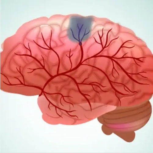 Cerebrovascular-Disease